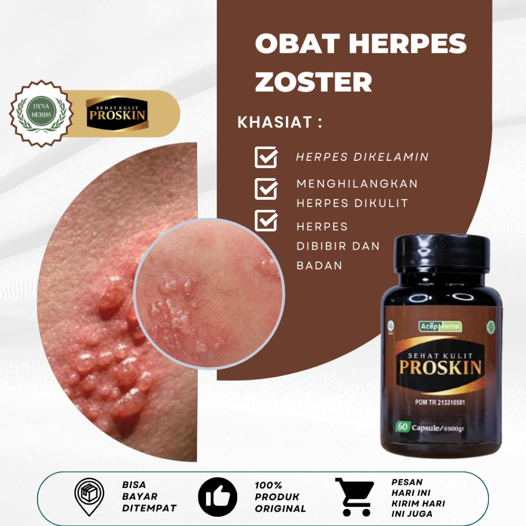 Obat Herpes Kulit, Obat Herpes Kelamin, Obat Herpes Genital, Obat Herpes Zoster, Obat Herpes Genital