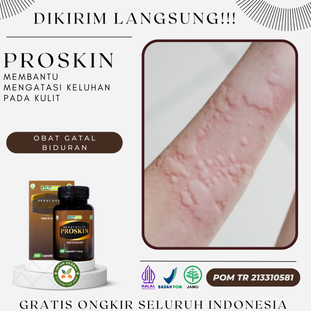 Proskin 100% Original - Obat Biduran, Gatal Biduran, Biduran Menahun, Biduran Kronis, Alergi Dingin,