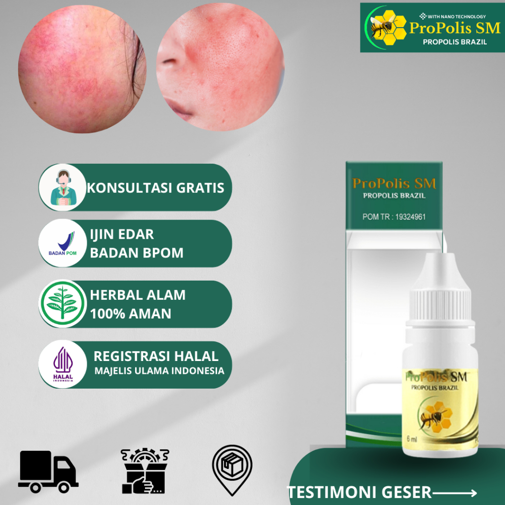 Obat Oles Penghilang Spider Veins Original BPOM, Obat Tetes Spider Veins ( Urat muka) Obat Tetes Ura