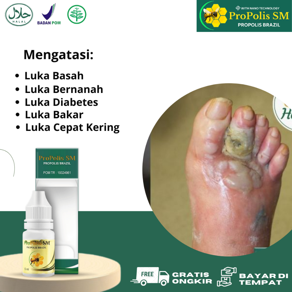 Obat Pengering Luka Basah, Luka Diabetes Bernanah, Luka Bakar, Luka Robek/Sobek, Luka Koreng, Luka S