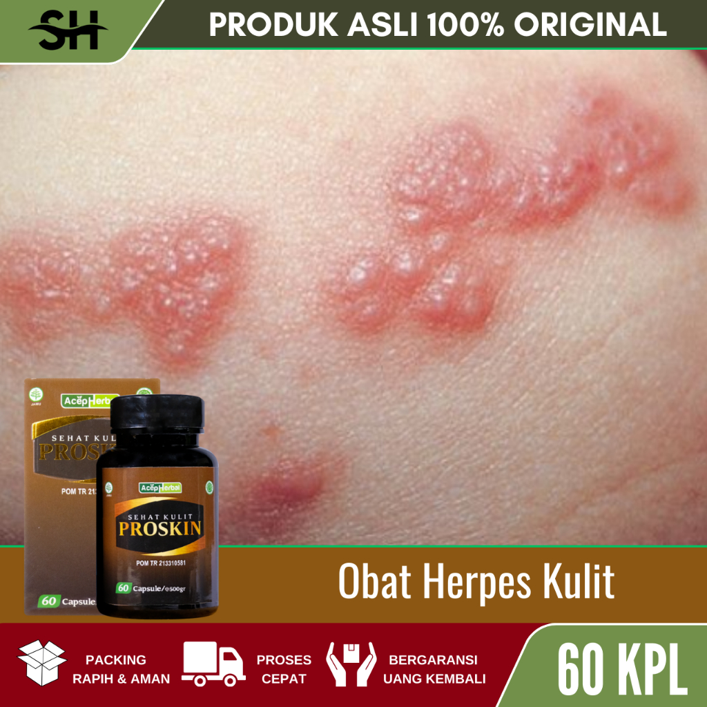 Obat Herpes Kulit, Obat Herpes, Obat Herpes Kelamin, Obat Herpes Zoster, Obat Herpes Kulit,  Obat He