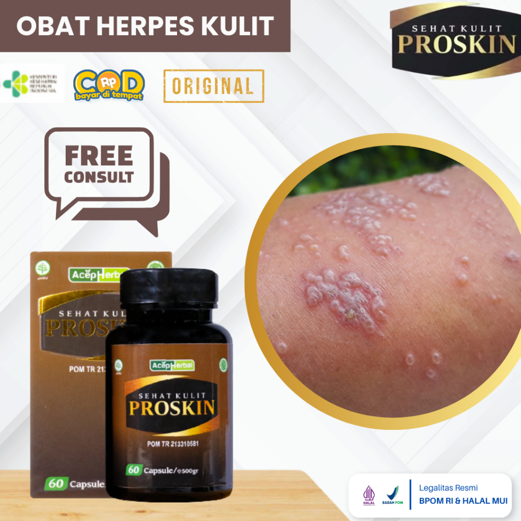 Obat Herpes Kulit, Penyakit Herpes, Obat Penghilang Herpes, Obat Virus Herpes, Obat Herpes Zooster, 
