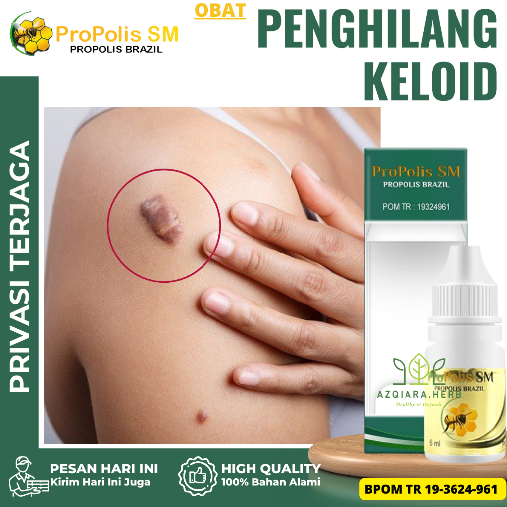Obat Keloid, Obat Penghilang Keloid, Obat keloid Dan Bekas Luka, Obat Daging Tumbuh, Obat Penghilang
