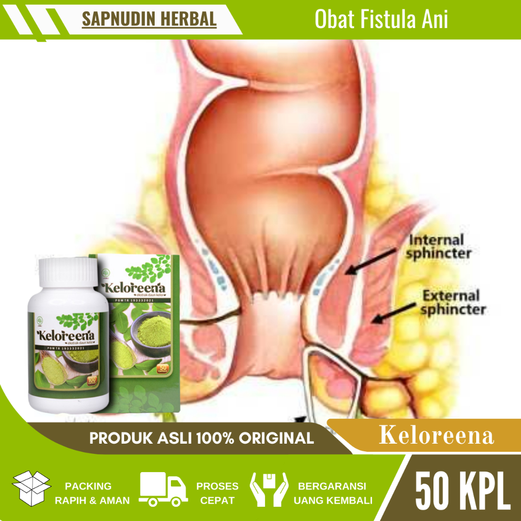 Obat Fistula Ani, Obat Luka Fistula Ani, Jamu Herbal Fistula Ani, Obat Benjoan Fistula Ani, Obat Pen