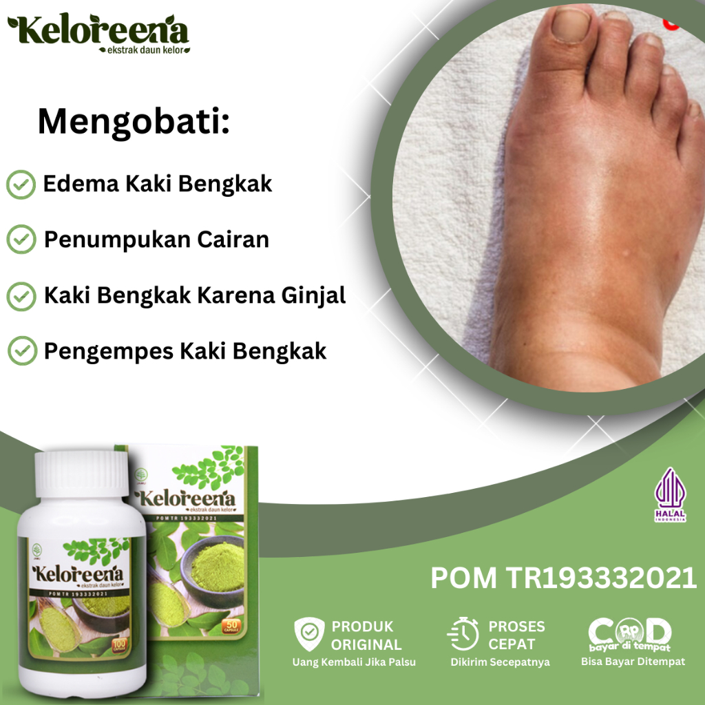 Obat Kaki Bengkak, Obat Edema Kaki Bengkak, Obat Asam Urat, Obat Pengempes Kaki Bengkak, Obat Kaki B