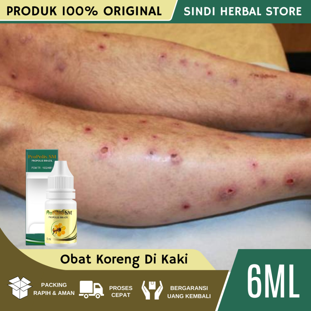 Obat Koreng di Kaki, Penghilang Bekas Luka Hitam Koreng, Obat Penghilang Bekas Luka, Obat Penghilang