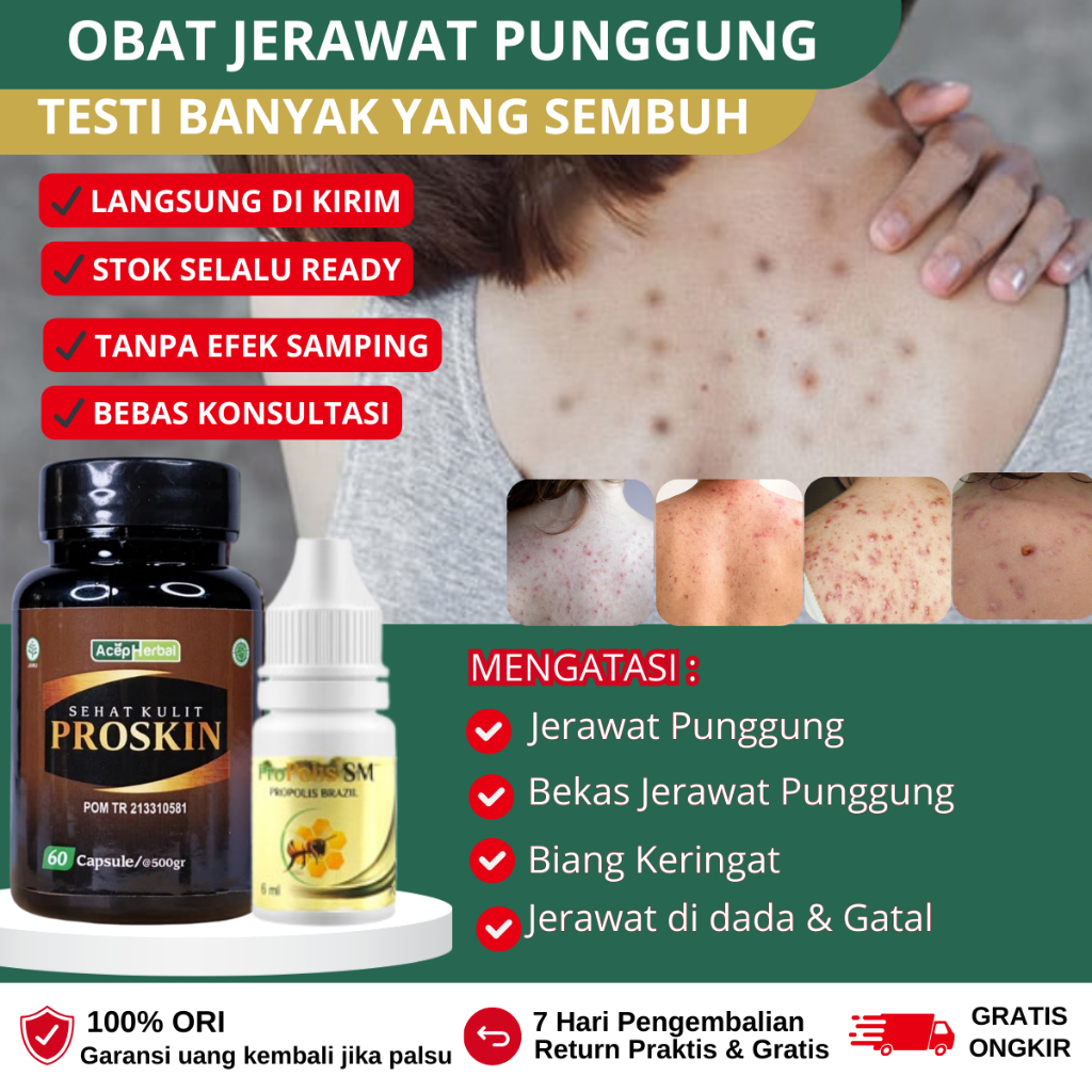 Penghilang Jerawat di dada dan badan, Obat Gatal Seluruh Badan, Obat Jerawat punggung dan dada, Crea