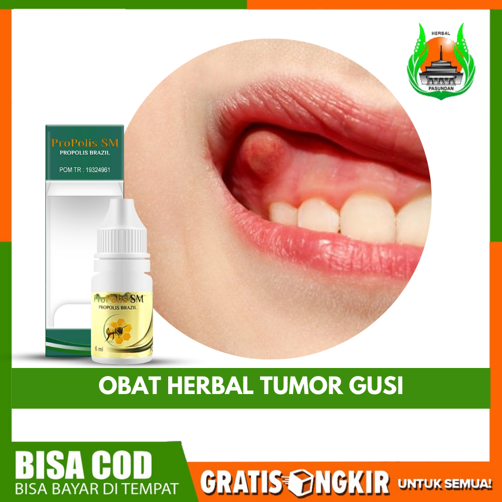 Obat Herbal Tumor Gusi, Tumor Gigi, Benjolan Di Gusi, Gusi Berdarah,Tumor Jinak Gigi, Mencegah Tumor