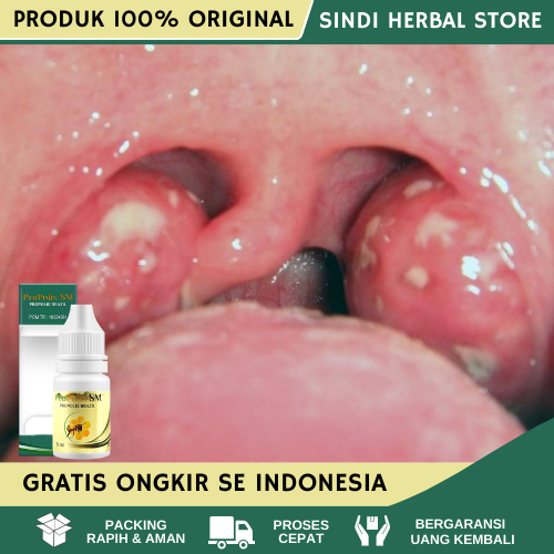 Obat Amandel, Obat Untuk Amandel, Obat Radang Amandel, Obat Amandel Anak, Obat Amandel Dewasa, Obat 
