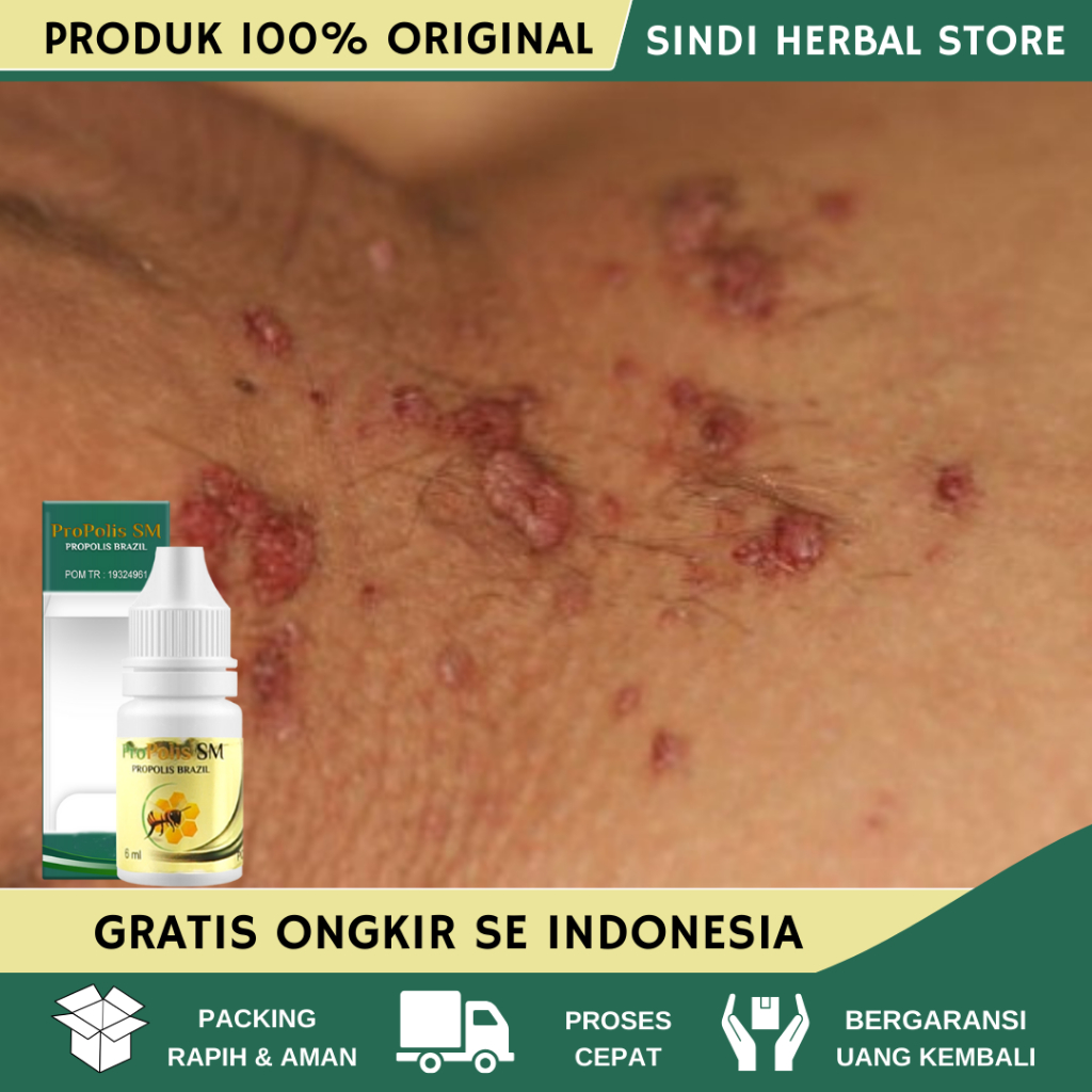 Obat Kutil Kelamin, Perontok Kutil Kelamin, Penghilang Kutil Kelamin, Menghilangkan Kutil Kelamin, P