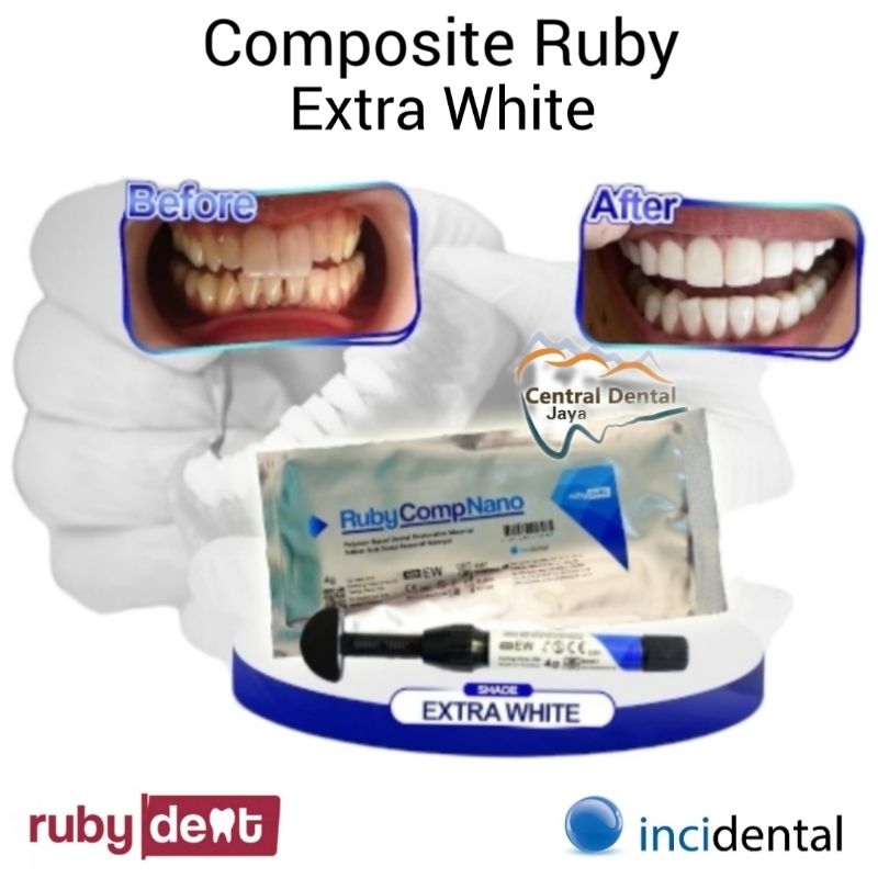 Composite Ruby Comp Nano Veneer Extra White EW (Extra Bleach) / Komposit Veneer Gigi Super Putih dan