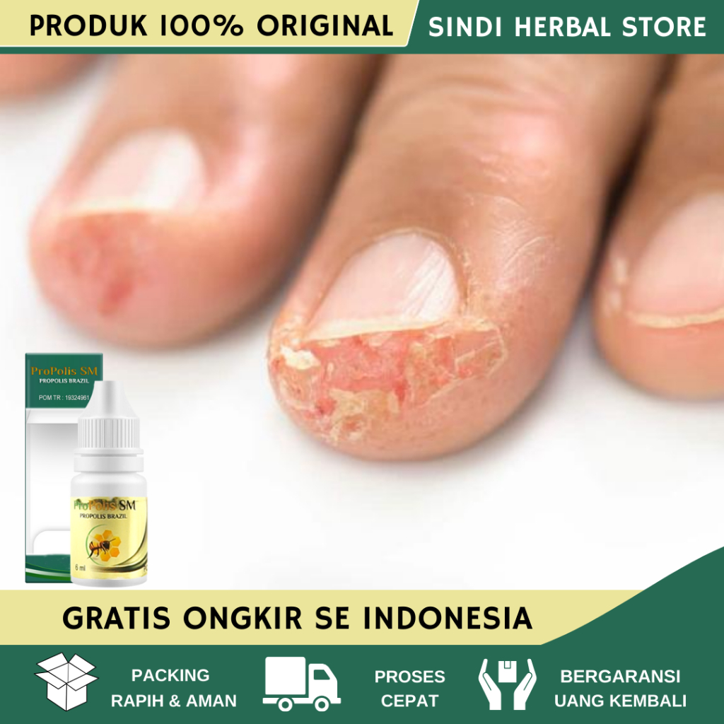 Obat Kulit Jari Tangan Kering Pecah Pecah, Obat Kulit Kering Jari Tangan, Obat Gatal Di Jari Tangan,