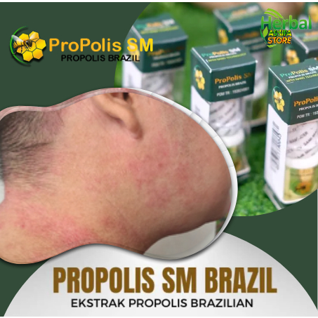 Obat Penghilang Gatal Gatel di Selakangan, Leher Daerah Kelamin, Di Kaki, Paha Bukan Salep Cina | He