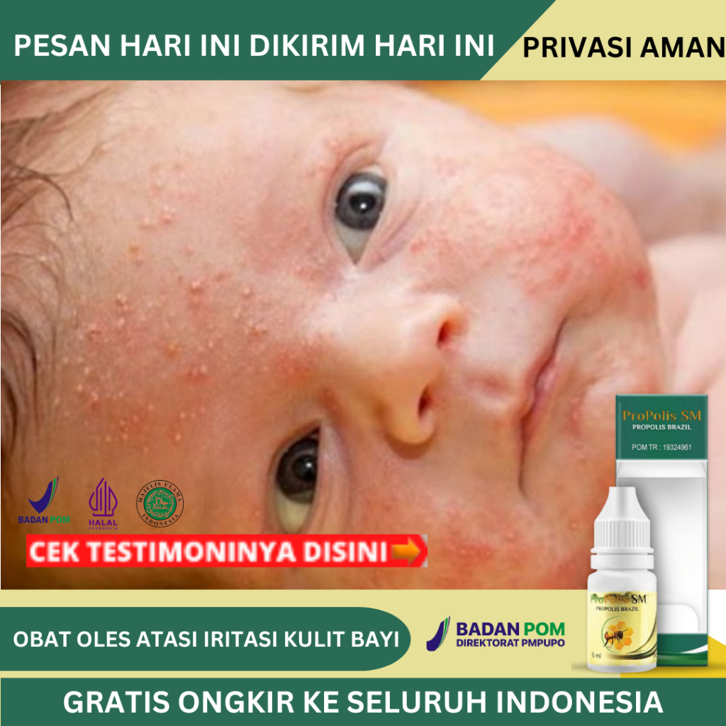 Obat Iritasi Kulit Bayi Bruntusan Gatal Memerah, Biang Keringat, Alergi Kulit Bayi, Ruam Popok, Kuli