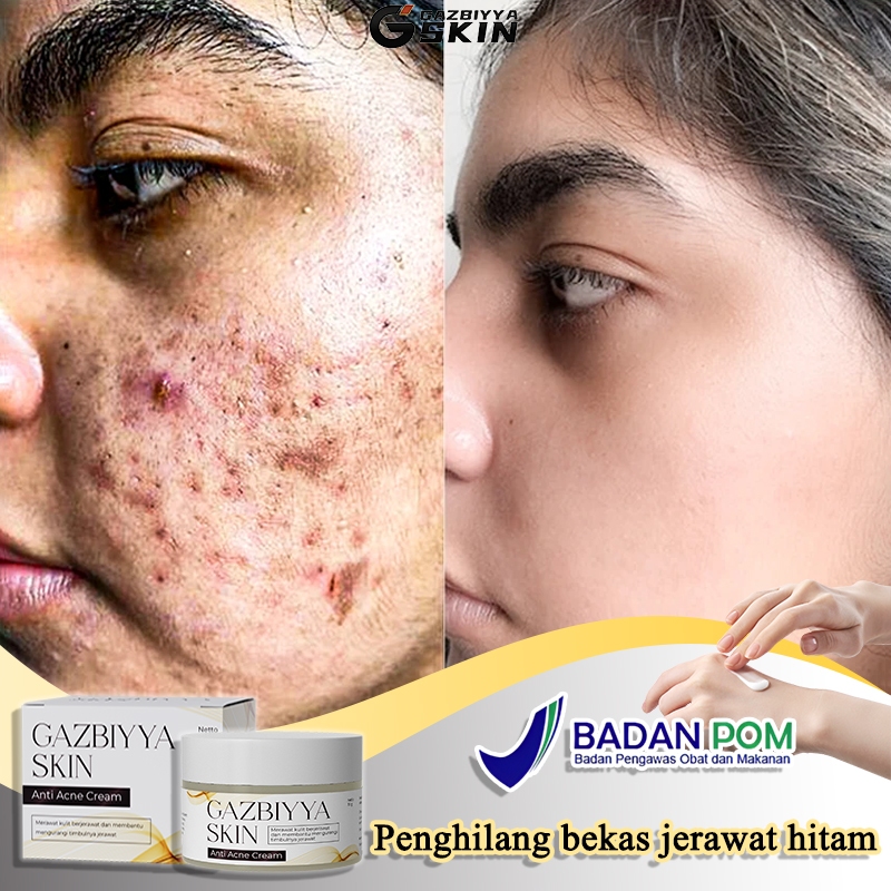 Penghilang bekas jerawat penghilang jerawat dan bekas jerawat obat penghilang bekas jerawat 30g obat