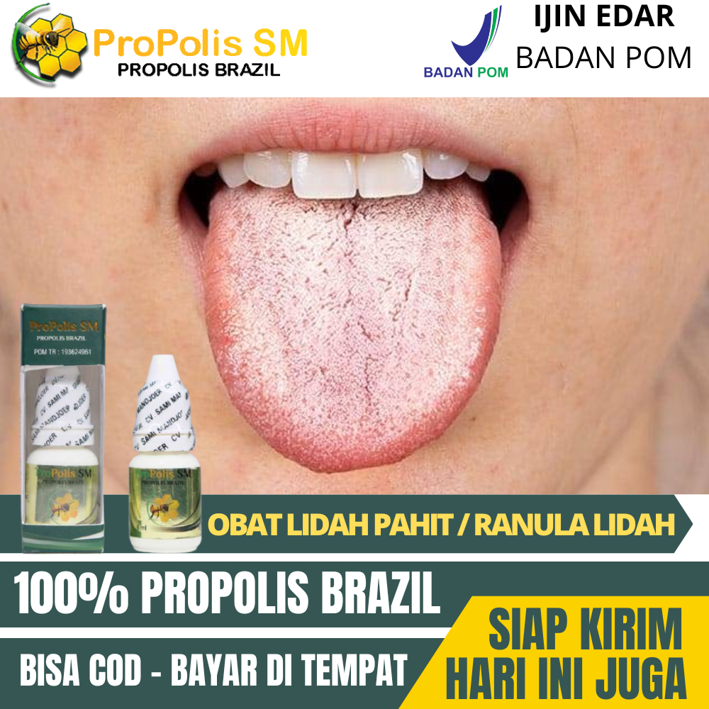 Obat Lidah Terasa Pahit, Mulut Pahit, Lidah Putih, Benjolan di Bawah Lidah, Tumor Lidah, Ranula Lida