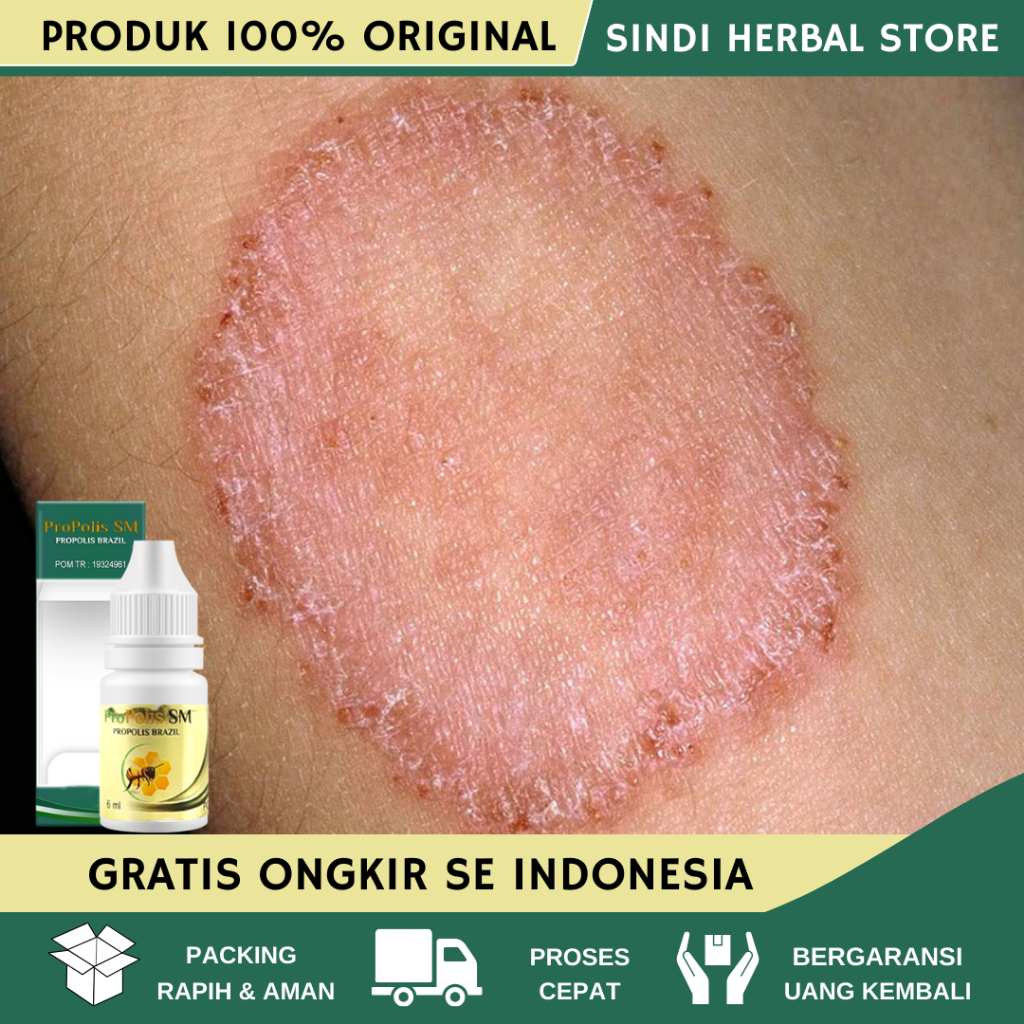 Obat Gatal Pantat - Obat Gatal Pantat Anak dan Dewasa - Obat Gatal dan Budug di Pantat - Obat Kulit 