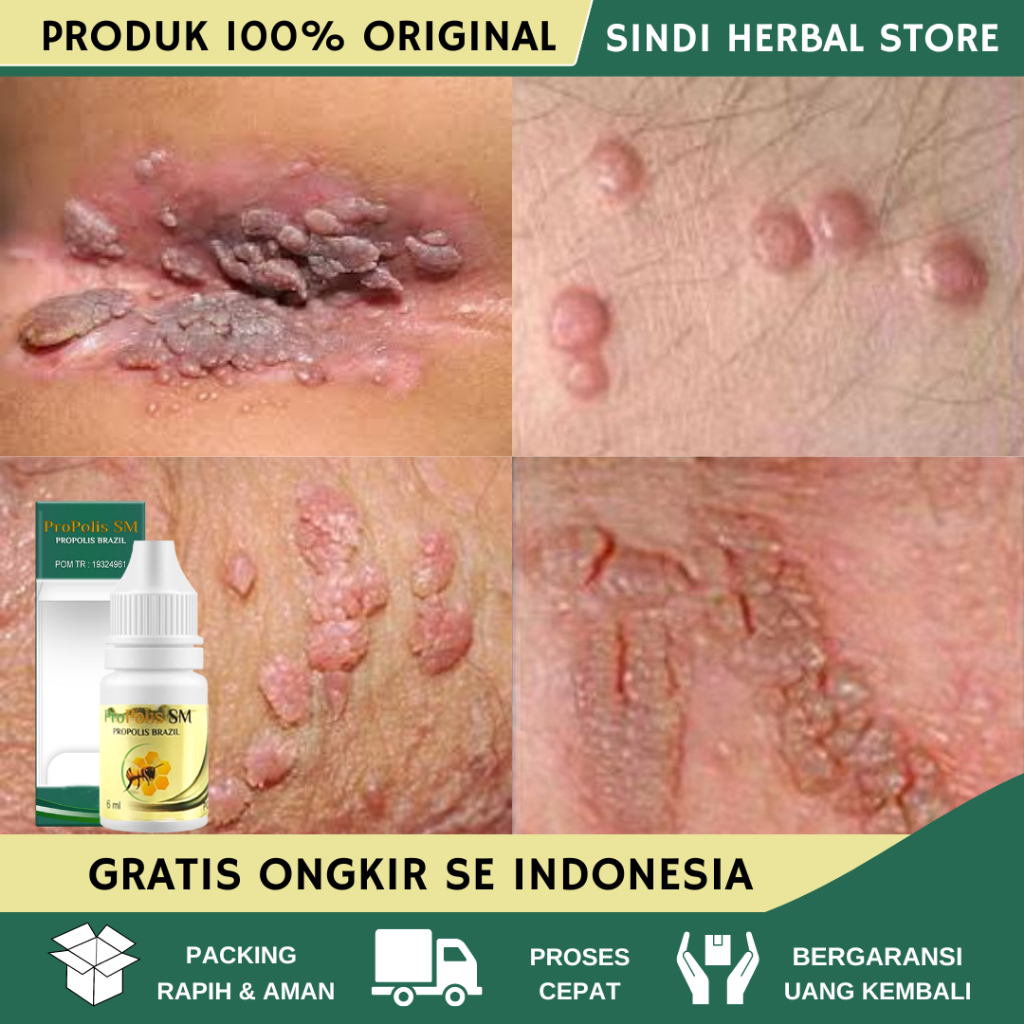 Obat Kutil Kelamin, Obat Kutil Kelamin Laki Laki, Obat Kutil Kelamin Wanita, Obat Kutil Kelamin HPV,