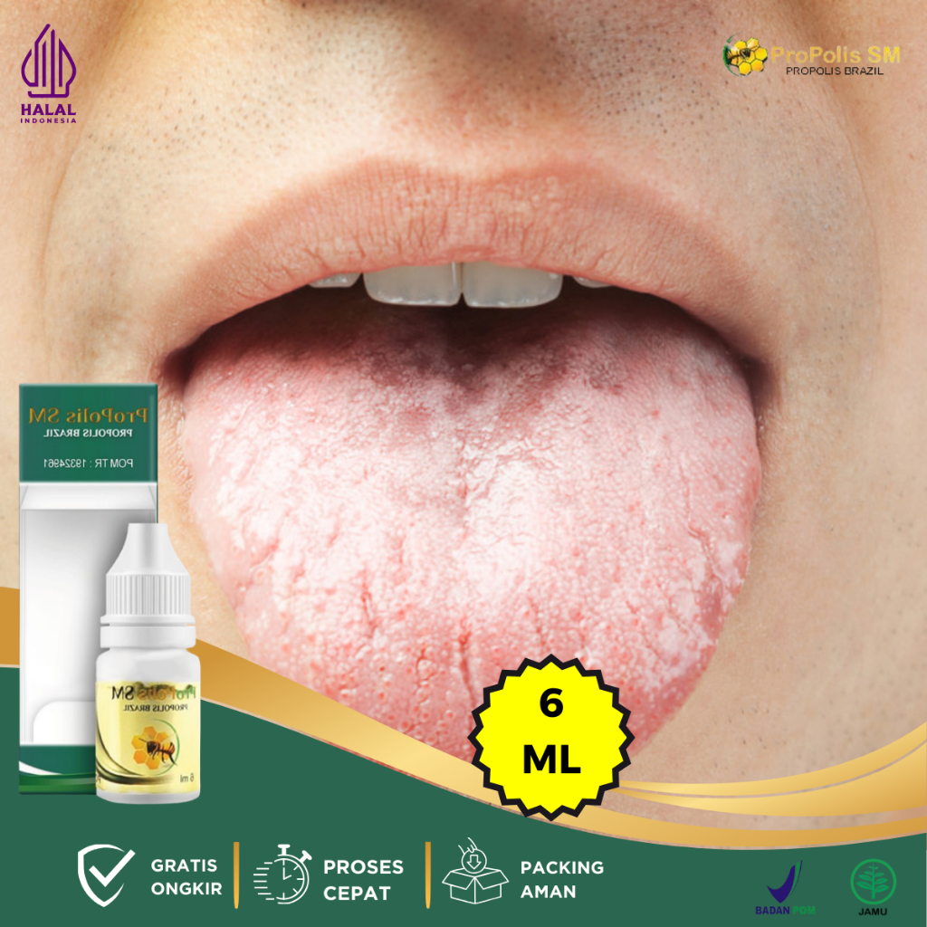 Obat Lidah Putih, Obat Lidah Putih Berjamur, Obat Benjolan Di Lidah, Obat Lidah Luka, Obat Lidah Pec