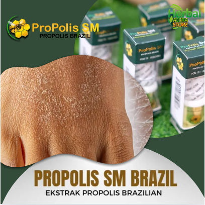 Obat Penghilang kulit kering bersisik dan gatal, Salep Cair Gatal Gatel di Kaki, Tangan Kulit kering