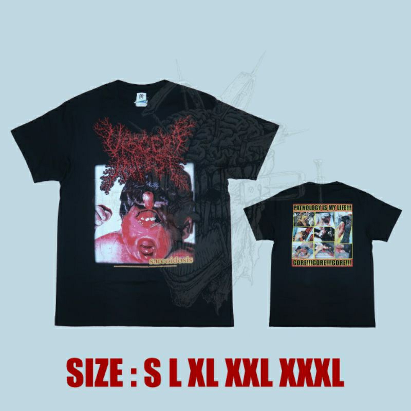 TS - VISCERA INFEST - Sarcoidosis