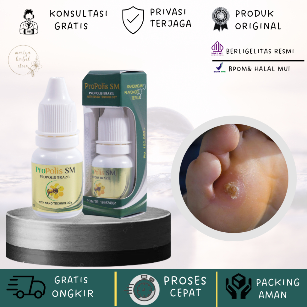 Obat Herbal Mata Ikan Obat Mata Ikan Di Telapak Kaki Obat Mata Ikan di Telapak Tangan Obat Penghilan