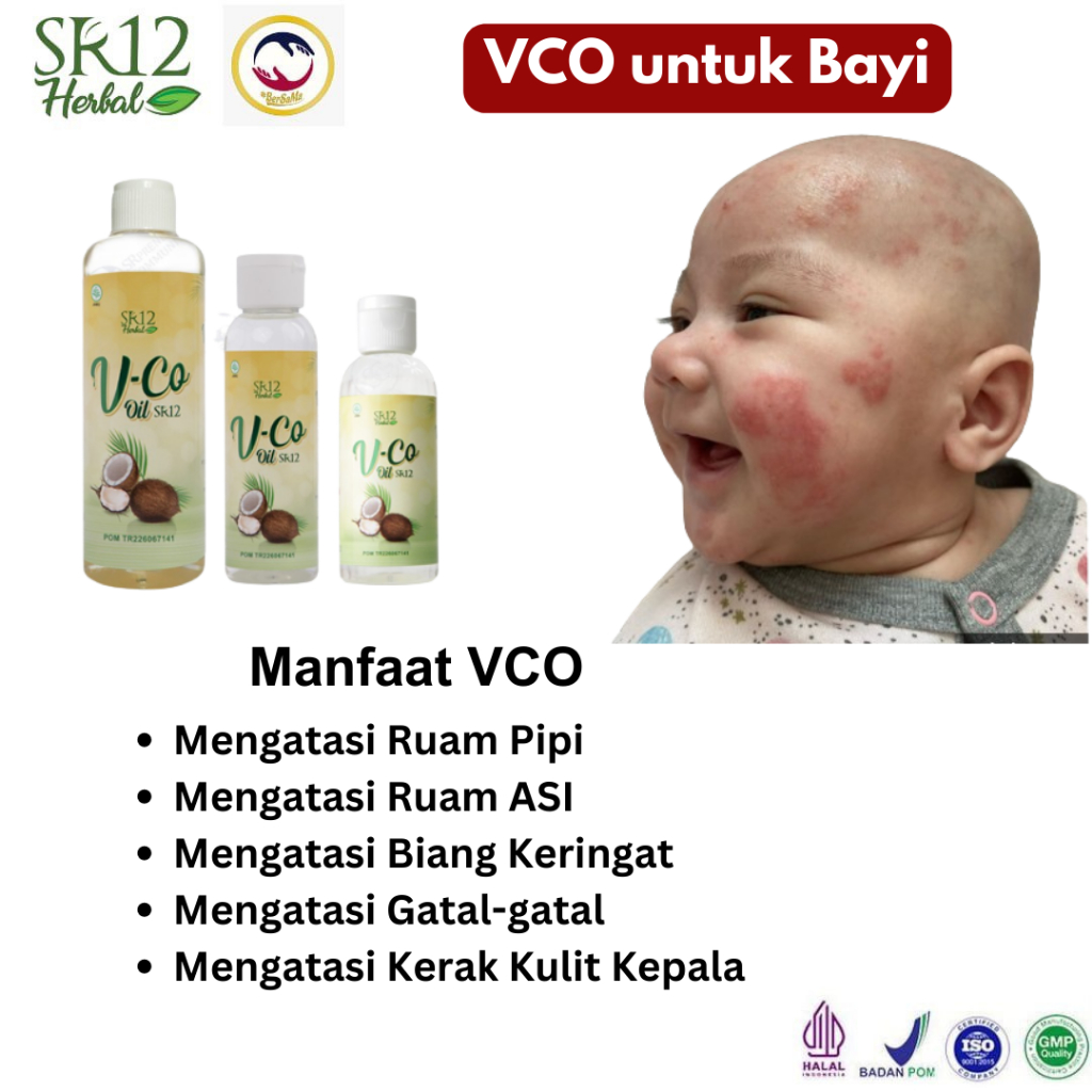 Obat Oles untuk Ruam Pipi dan Ruam pada Popok Bayi Leher Merah Atasi Biang Keringat
