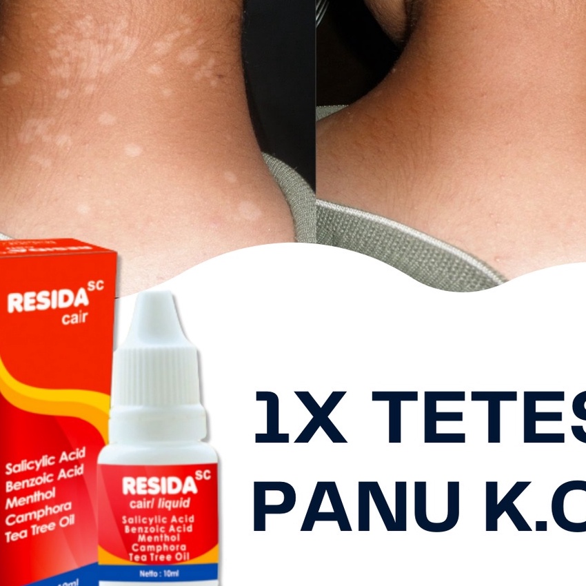KP8 Obat Panu Cair Paling Ampuh 1 Obat Panu Cair Resida Original BPOM Penghilang Gatal Jamur Kadas K