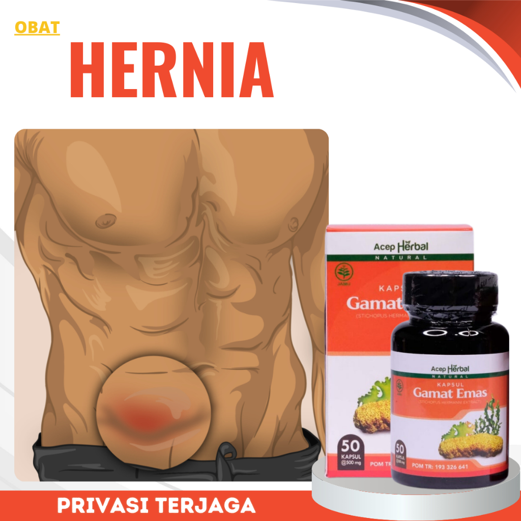 Obat Hernia, Obat Hernia inguinalis, Obat Hernia femoralis, Obat Hernia umbilikalis, Obat Hernia hia