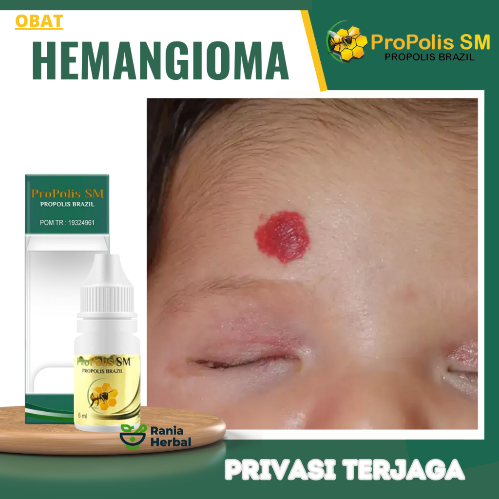 Obat Hemangioma, Penghilang Benjolan Kemerahan , Obat  Tumor Hemangioma, Obat Penghilang Benjolan Ke