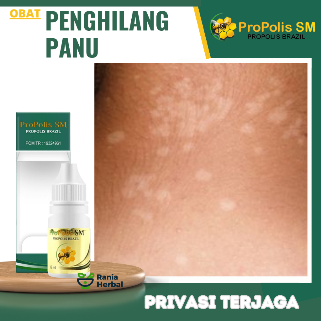 Obat Penghilang Panu, Obat Panu Anak, Obat Panu Di Wajah, Obat Balas Bogo, Obat Bercak Putih Di Kuli
