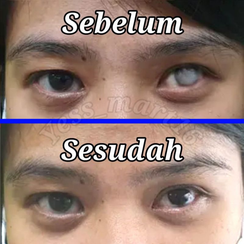 Lensa mata cacat softlens prosthetic iris lensa mata cacat menutupin iris putih dan pupil softlens m