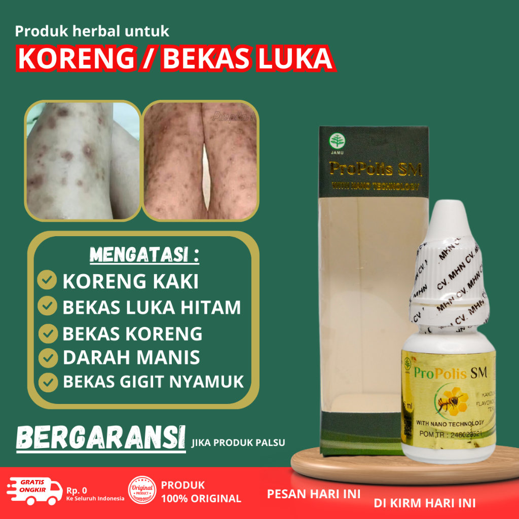 Penghilang bekas Luka di kaki - Obat Penghilang Koreng di Kaki - Obat Penghilang koreng budug Gatal