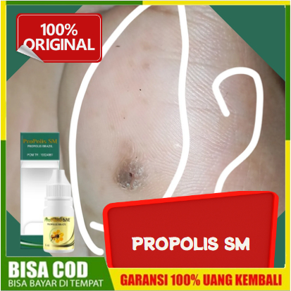 Obat Mata Ikan Menahun / Bukan Obat Cina - Obat Kutil, Kapalan, Kutu Air - Herbal Propolis SM