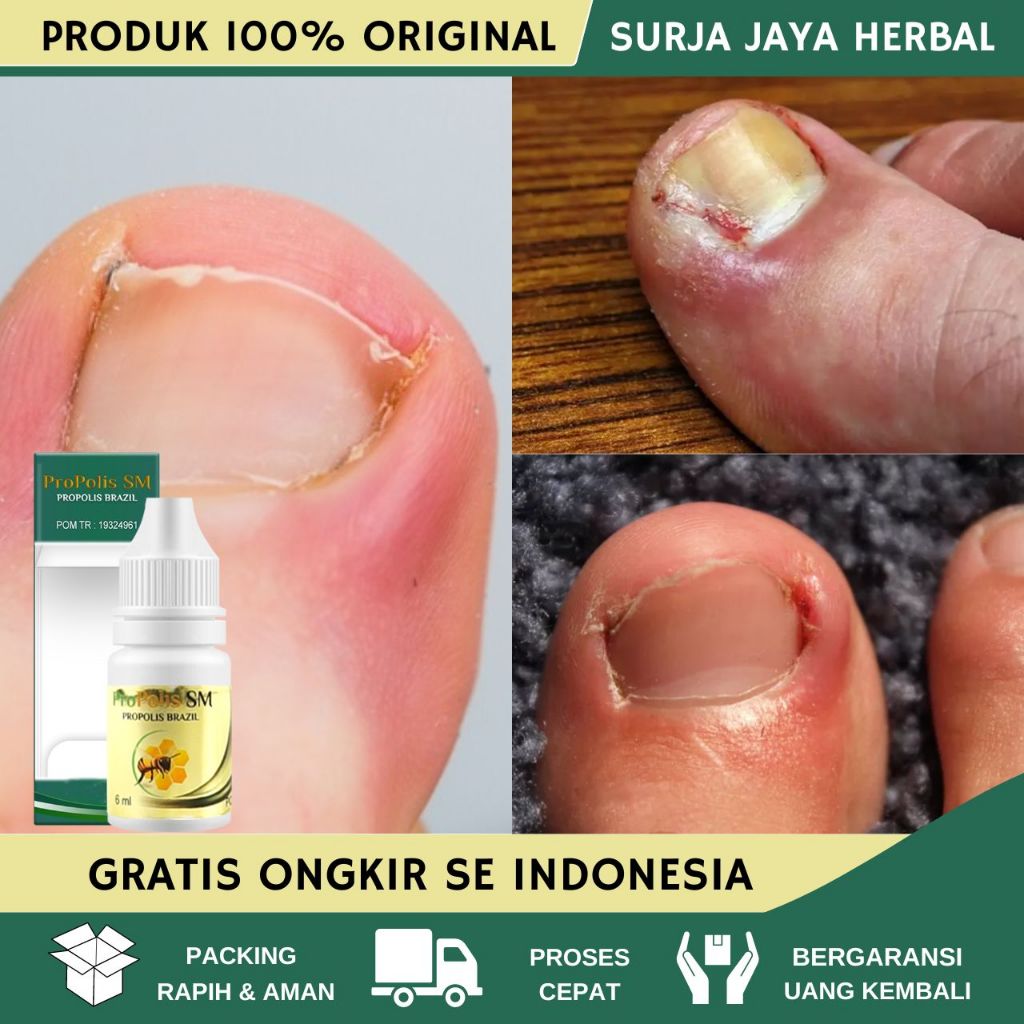 obat tetes cantengan, obat cantengan jari tangan dan kaki bengkak nyeri bernanah bau parah