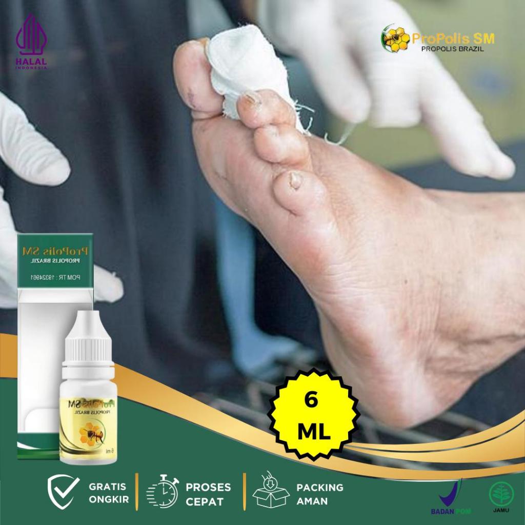 Obat Pengering Luka Diabetes Basah Bernanah, Obat Luka Diabetes, Obat Luka Diabetes Kering, Obat Luk