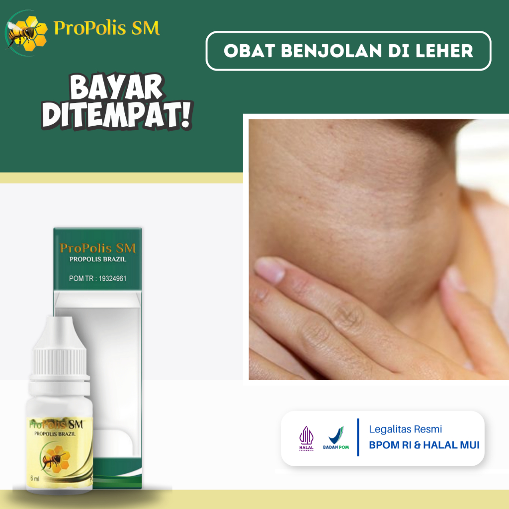 Obat Benjolan Di Leher, Obat Oles Penghilang Benjolan Di Leher, Obat Tiroid Membesar, Obat Kelenjar 