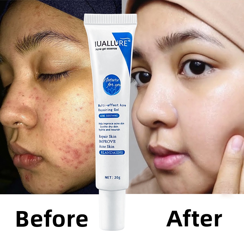 IUALLURE PENGHILANG JERAWAT 20G JERAWAT PARAH MERADANG BOPENG KRIM ACNE GLOW WHITE SALICYLIC ACID AC