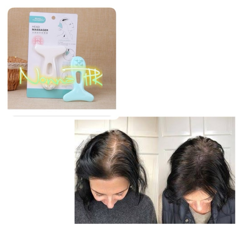 Penumbuh Rambut Botak Paling Ampuh dan Cepat Penumbuh Rambut Botak dan Rontok Hair Growth Treatment