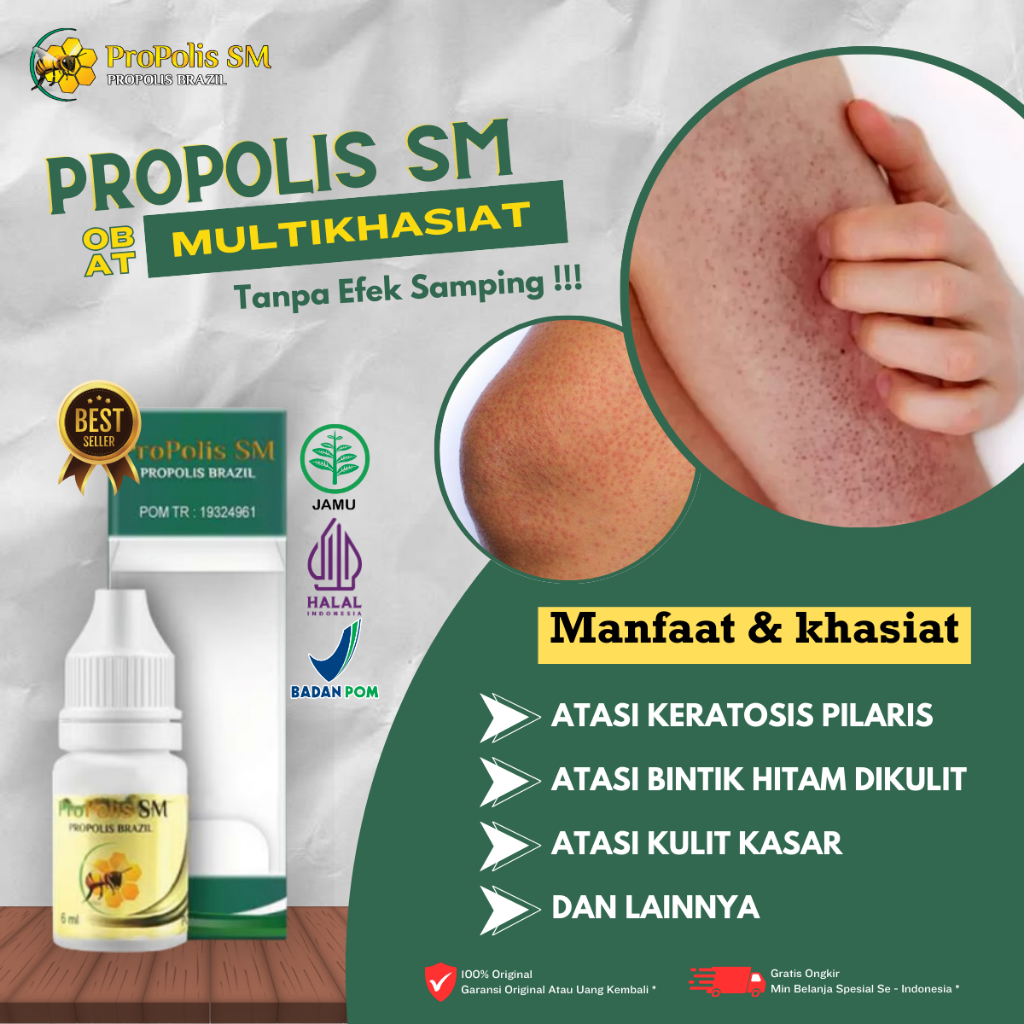 Obat Keratosis Pilaris, Obat Kulit Keratosis Pilaris, Obat Penyakit Kulit Ayam, Obat Untuk Mengatasi