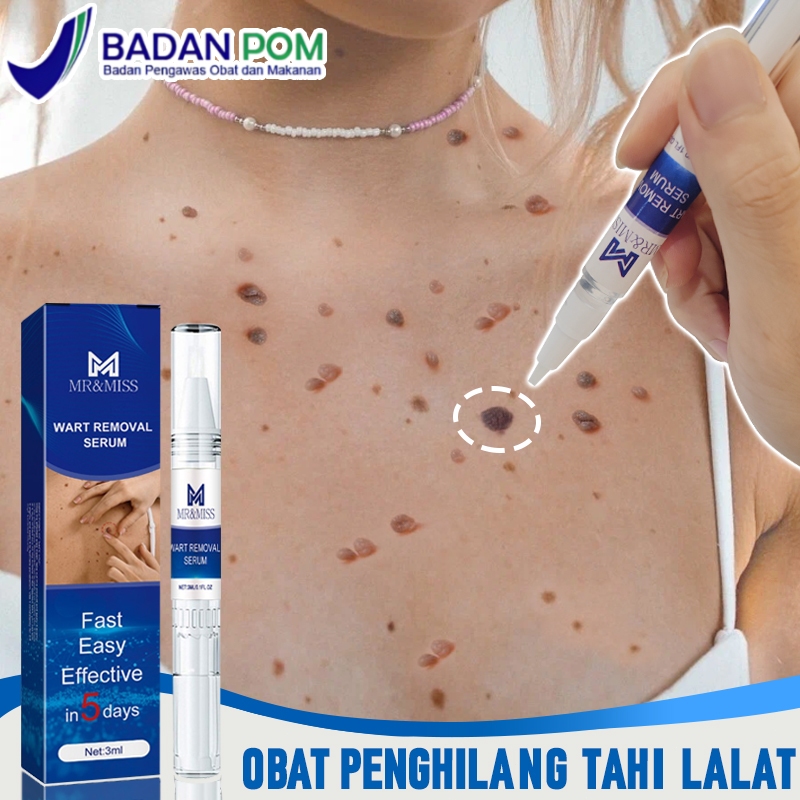 Penghilang kutil dan tahi lalat Penghilang tahi lalat di wajah Obat kutil Obat Penghilang Kutil 100%