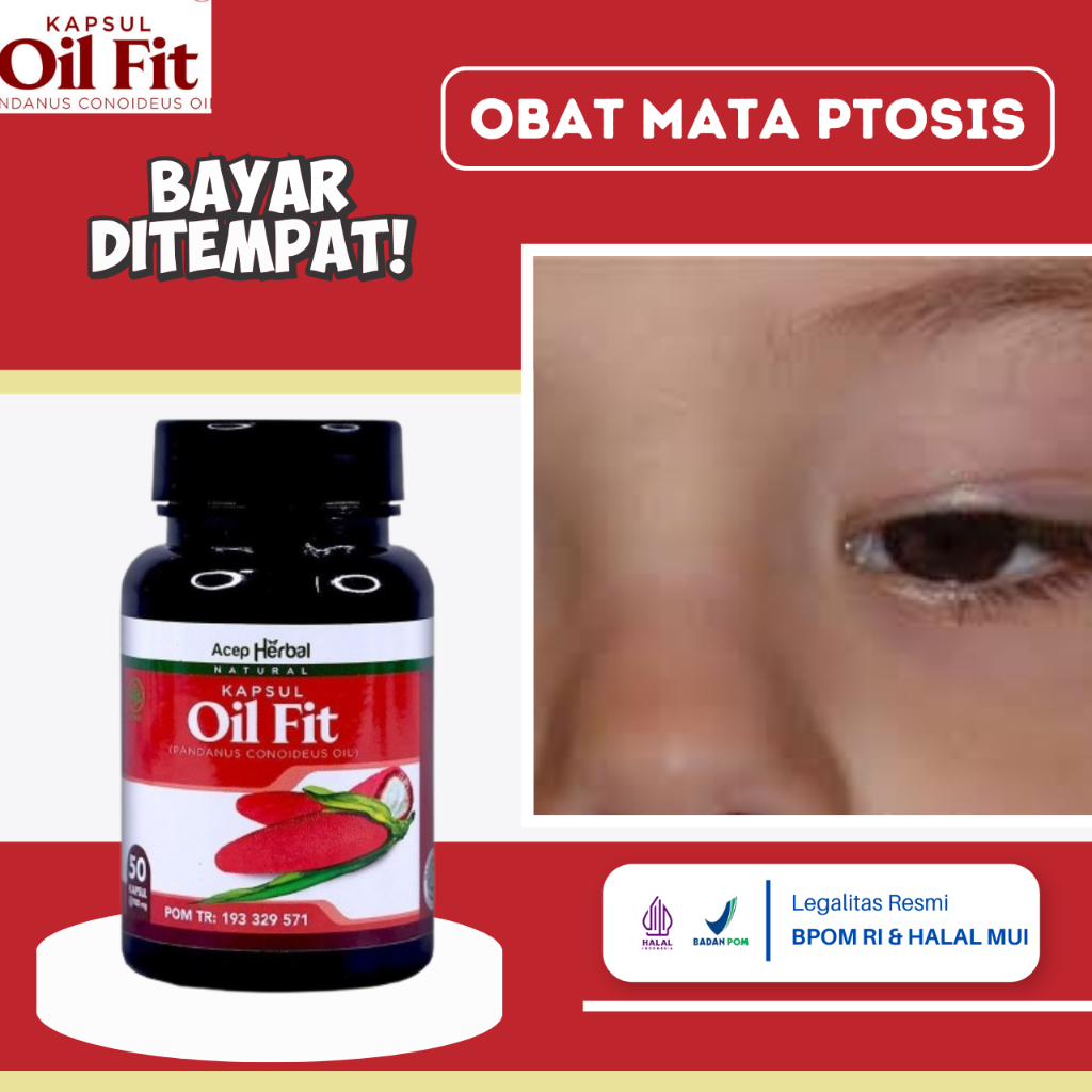 Obat Mata Ptosis, Obat Kelopak Mata Turun Sebelah, Obat Mata Beda Sebelah, Obat Penyakit Mata Ptosis