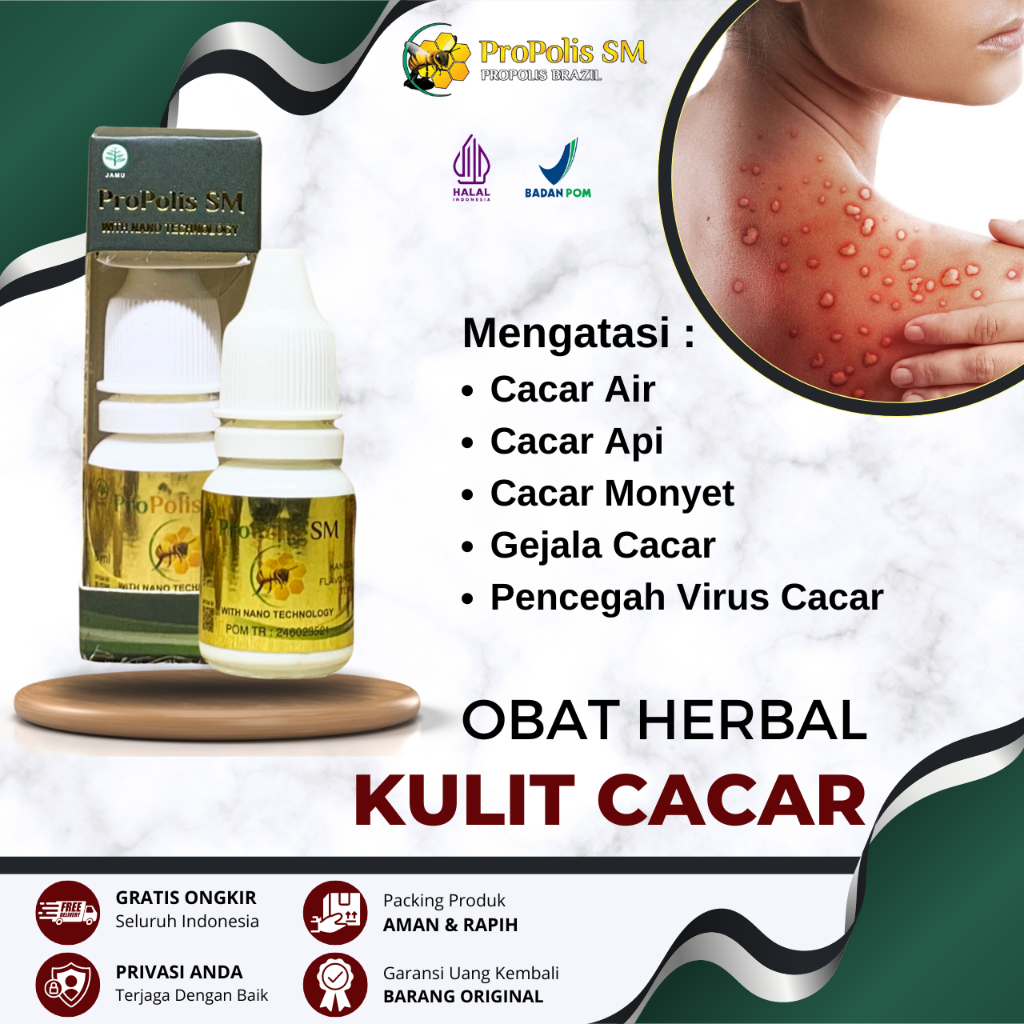 Obat Cacar Anak dan Dewasa, Obat Cacar Air Cacar Monyet Cacar Api, Obat Penyakit Cacar, Pencegah Vir