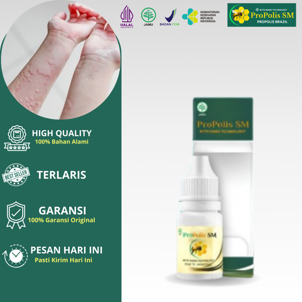 Obat Biduran Kaligata Alergi Gatal Gatal Biduran Akut Biduran Kronis Menahun Obat Biduran Alergi Din
