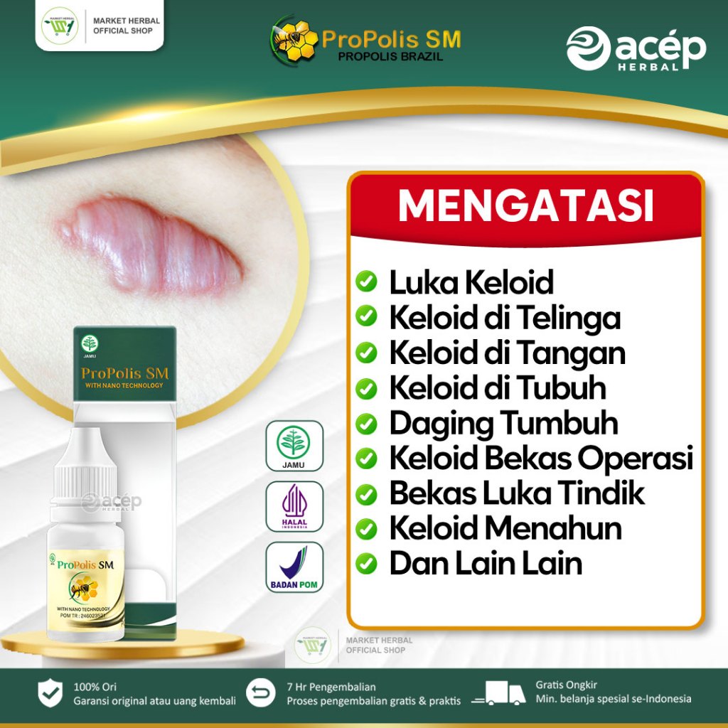Obat Benjolan Keloid Daging Tumbuh Menahun Bekas Operasi Injeksi Di Dada Tangan Telinga Propolis SM