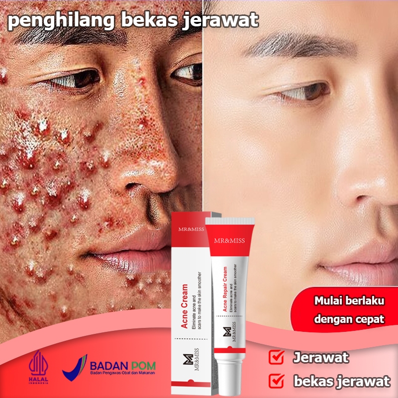 Salep jerawat Menghilangkan bekas jerawat Obat totol jerawat Penghilang bekas jerawat Obat jerawat 2