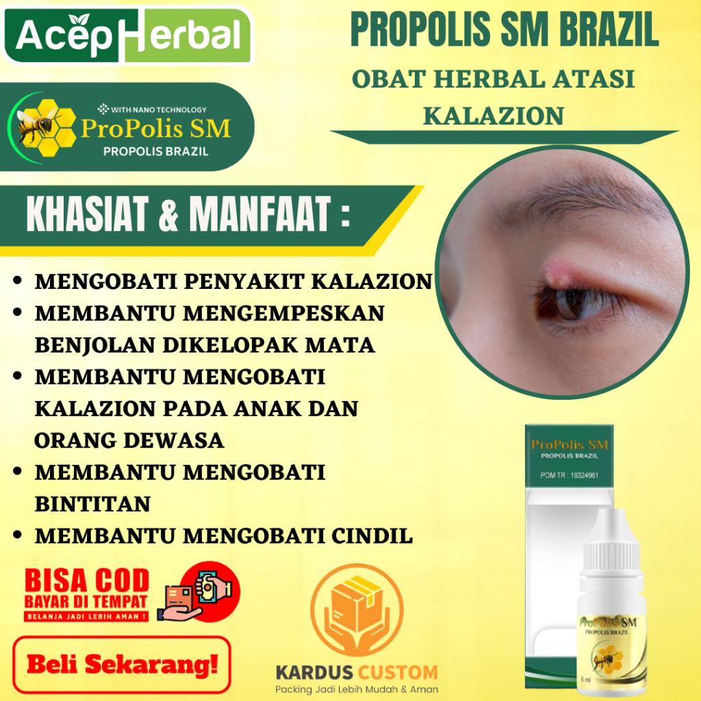 Obat Kalazion - MENGEMPESKAN BENJOLAN DI KELOPAK MATA - Obat Kalazion Anak, Obat Kalazion Dewasa Oba