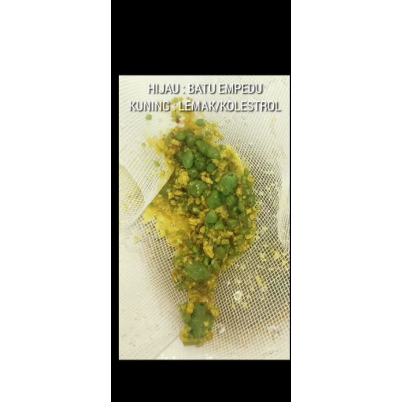 

herbal tuntaskan batu empedu keluar secara alami.hanya.dalam.waktu 6 hari insya allah , ulu hati | sembuh alami | sakit pinggang | detoks perut |