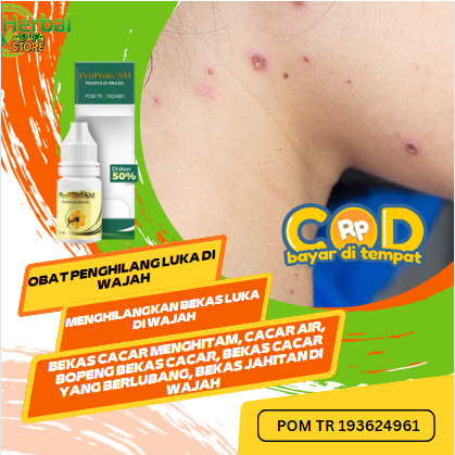 Obat Penghilang luka di wajah | Menghilangkan Bekas Luka Di Wajah, Bekas Cacar Menghitam, Cacar Air,