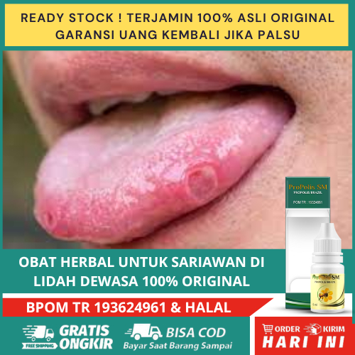 Obat Sariawan Lidah Alami Formula Alami untuk Mengatasi Sariawan pada Lidah  Sariawan Lidah Dewasa M